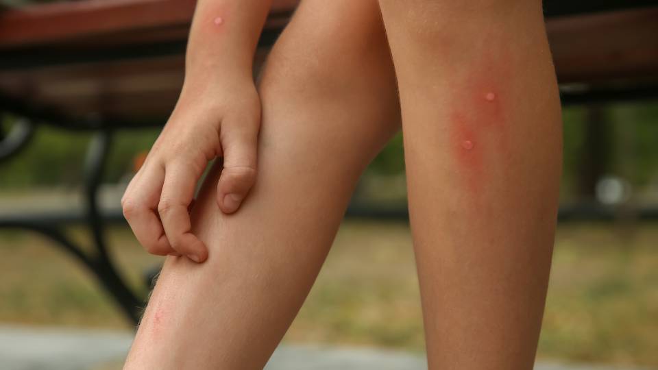 someone with bug bites from UK pests